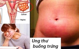 Nếu bạn có 10 dấu hiệu này, hãy nghi ngờ ung thư buồng trứng