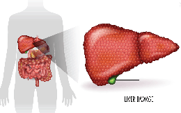 Uống rượu làm hỏng gan chỉ đứng thứ hai, "sát thủ" đứng số 1 rất nhiều người trẻ đang làm