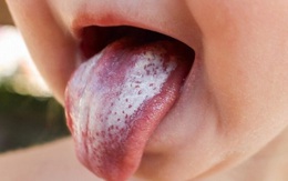 Cảnh báo sức khỏe qua màu lưỡi