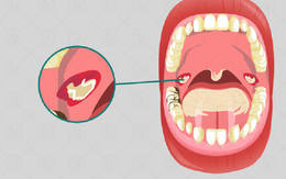 Bệnh nhi 4 tuổi tử vong do bệnh bạch hầu dù đã tiêm vắc xin: Chuyên gia lý giải nguyên nhân