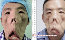 Bác sĩ Sài Gòn tìm cách cứu người đàn ông sống kiếp “mặt quỷ”, ngủ ngồi và mắt luôn đỏ như máu trong suốt 15 năm