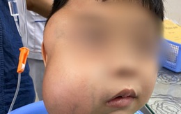 Bé trai 13 tuổi mang khối u xơ vòm họng "khổng lồ" lần đầu tiên ghi nhận tại Việt Nam