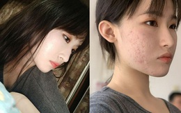 Mặt mộc không hoàn hảo của hotgirl Trung Quốc: Góc nghiêng cực phẩm, đường nét thanh tú cũng không thể che giấu sự thương tổn đáng sợ trên gương mặt