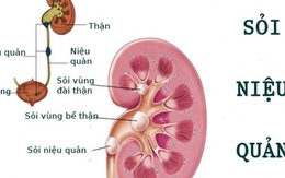 Sỏi niệu quản có nguy hiểm?