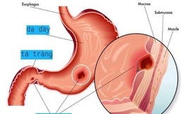 5 quy tắc cho người bị viêm dạ dày