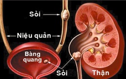 Biến chứng khó lường của sỏi niệu quản