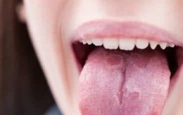 Xuất hiện 3 triệu chứng mới là dấu hiệu ban đầu mắc COVID-19