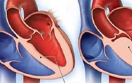 Viêm cơ tim sau tiêm vaccine COVID- 19 có đáng ngại?