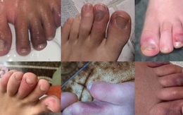 Lý giải triệu chứng 'ngón chân co cứng' xuất hiện ở bệnh nhân mắc COVID-19