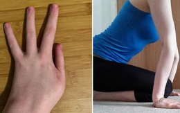 14 dị nhân có đặc điểm cơ thể siêu thú vị: Người 4 ngón, kẻ vặn ngược tay