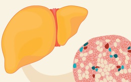 Gan nhiễm mỡ: Nhận biết dấu hiệu, nguyên nhân và điều trị sớm để ngừa xơ gan