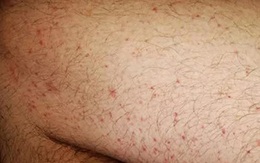 Phát ban có phải là dấu hiệu của COVID-19 không?