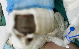 Xông lá thuốc phòng Covid-19, bé gái bỏng hết khuôn mặt