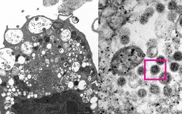 Triệu chứng COVID-19 đặc trưng dần biến mất trên biến thể Omicron