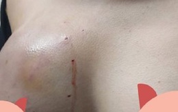 Đầu năm bác sĩ thẩm mỹ tiếp nhận nhiều ca biến chứng do làm đẹp