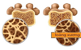 Nhận biết sớm bệnh loãng xương