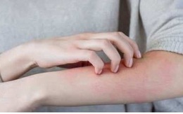 Những tác dụng phụ có thể xảy ra của vaccine COVID-19