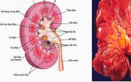 Dấu hiệu viêm cầu thận cấp