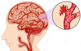 Bệnh nhân COVID -19 đối mặt với nguy cơ đột quỵ cao hơn