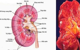 Bài thuốc hỗ trợ trị viêm cầu thận cấp