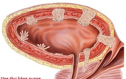 Các yếu tố nguy cơ gây ung thư bàng quang