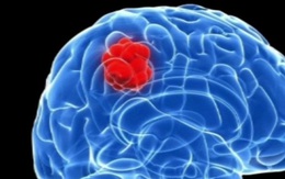 Israel tìm ra phương pháp mới ngăn chặn sự lây lan của tế bào ung thư não