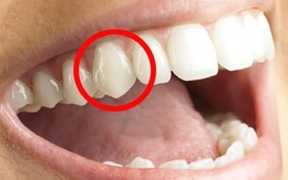 Tại sao răng nanh của con người lại nhọn?