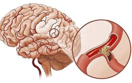 Nguyên nhân gây thiếu máu não