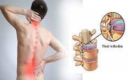 Mất hơn 100 triệu, suýt liệt sau bê chậu cây cảnh