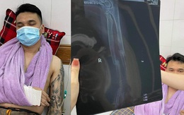 Khắc Việt nhập viện cấp cứu vì gãy tay, tạm thời cầm máu và bó nẹp chờ lên bàn mổ