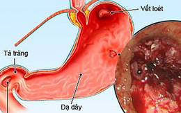 Phụ thuộc corticoid - bài học đắt giá