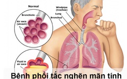 Phòng ngừa nguy cơ cho người bệnh phổi tắc nghẽn mạn tính trong dịch COVID-19