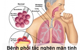 Phòng ngừa nguy cơ cho người bệnh phổi tắc nghẽn mạn tính trong dịch COVID-19