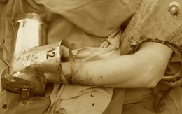 Người phụ nữ cùng máy xay thịt nuốt gần hết bàn tay đến bệnh viện