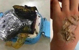 Smartwatch phát nổ khiến bé gái 4 tuổi bị bỏng