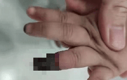 Cháu gái 3 tuổi bị đứt tay, bà dùng cách này cầm máu khiến bác sĩ buộc phải cắt cụt ngón tay đứa trẻ
