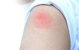 Phản ứng “cánh tay COVID-19” sau tiêm vaccine có đáng ngại?