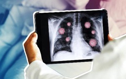 Viêm phổi COVID-19, triệu chứng và những điều cần biết