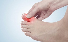 Nam giới mắc bệnh gout ngày càng nhiều, vì một lý do tưởng đơn giản