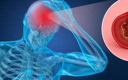 4 thói quen hàng ngày gây thiếu máu não dễ bị bỏ qua