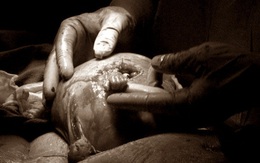 Thai nhi 21 tuần tuổi thò tay ra khỏi bụng mẹ và nắm chặt tay bác sĩ: Cuộc đời phi thường 20 năm sau khiến thế giới kinh ngạc