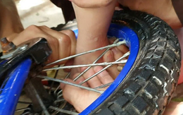 Bé gái 2 tuổi bị dập nát phần mềm gót chân do kẹt vào nan xe đạp