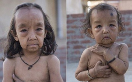 Cuộc sống của hai đứa trẻ sinh ra với gương mặt già nua hơn cả bố mẹ