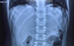 3 bệnh nhi ở Hải Phòng mắc COVID-19 bị thủng dạ dày