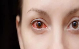 Cảnh báo 5 dấu hiệu nhiễm trùng mắt liên quan đến COVID-19