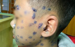 Phát ban đầy người tưởng hậu Covid-19 hoá ra mắc bệnh cực dễ lây lan