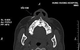 "Phát hoảng" với hình ảnh chụp cây kim gãy trong má bệnh nhân đi thẩm mỹ