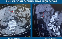 Cụ ông suýt chết vì bị xương cá xuyên thủng dạ dày