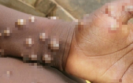 Lo ngại virus đậu mùa khỉ sẽ nối tiếp đại dịch COVID-19