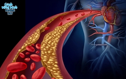 Mỡ máu cao - "sát thủ thầm lặng" gây đột quỵ: 4 nhóm người dễ mắc, số 1 đặc biệt nguy hiểm